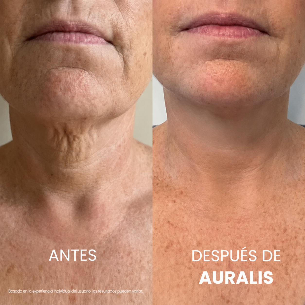 AURALIS®: Crema para estirar y levantar el cuello